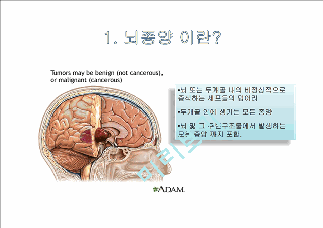 [4000원] 뇌종양종류 및 증상,양성종양 VS 악성종양,뇌종양 수술 방법,뇌종양에 좋은 음식,뇌농양,두부손상,두부손상 응급처치,두부손상에 의한 질환.pptx